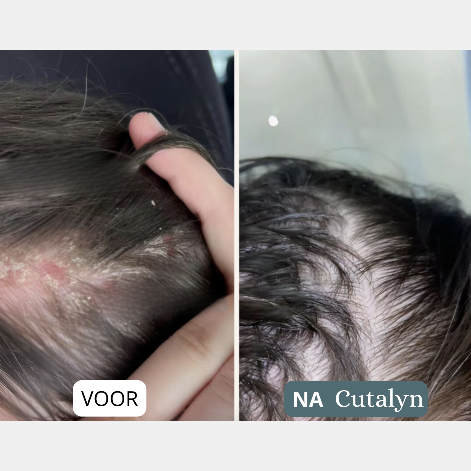 Cutalyn DermaRust® ⎜ Voor een zachte en rustige hoofdhuid en huid