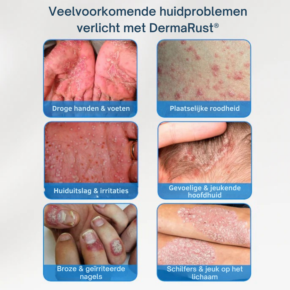 Cutalyn DermaRust® ⎜ Voor een zachte en rustige hoofdhuid en huid