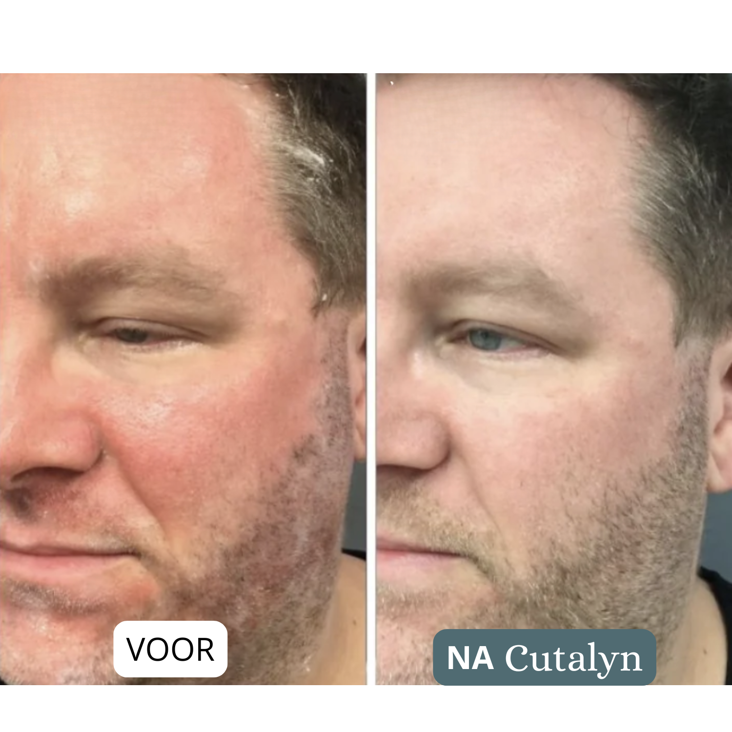 Cutalyn DermaRust® ⎜ Voor een zachte en rustige hoofdhuid en huid