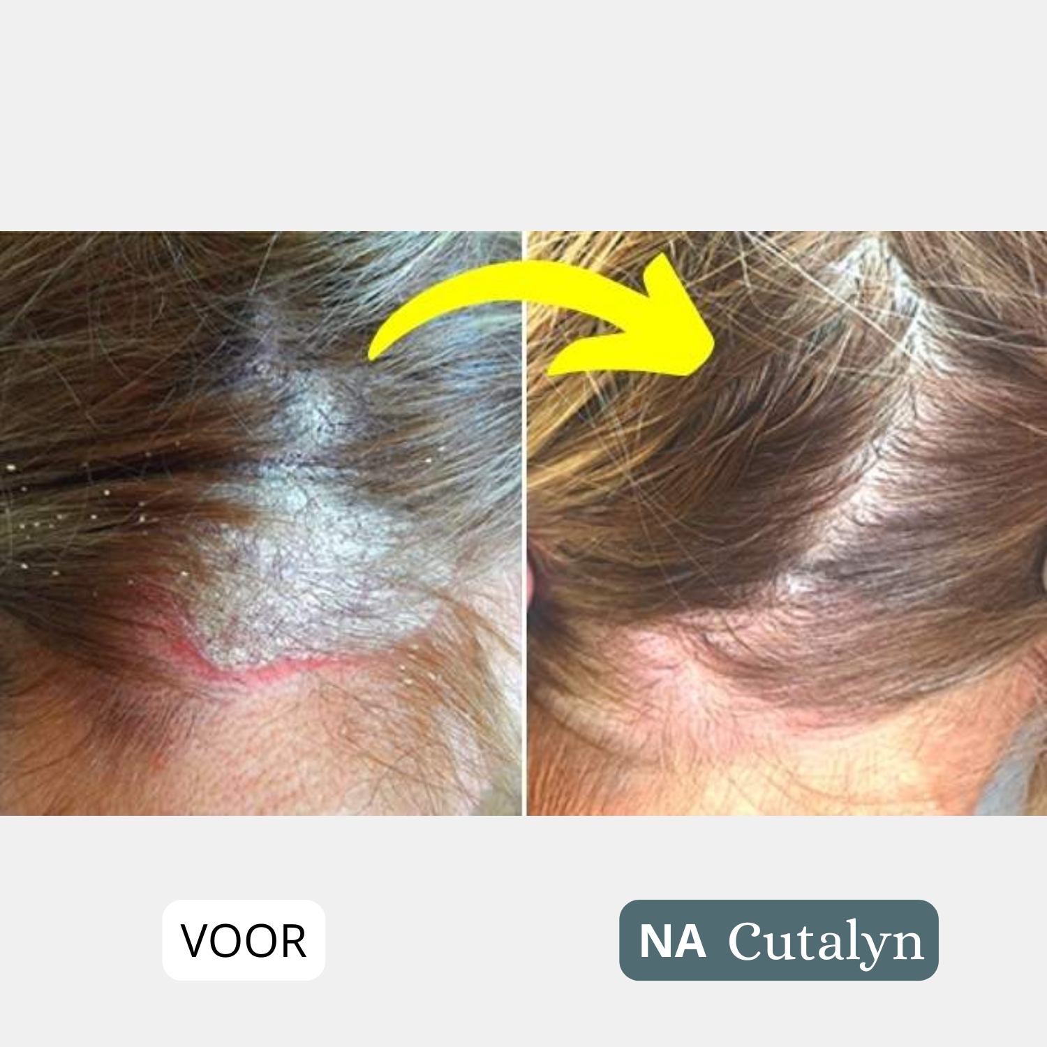 Cutalyn DermaRust® ⎜ Voor een zachte en rustige hoofdhuid en huid